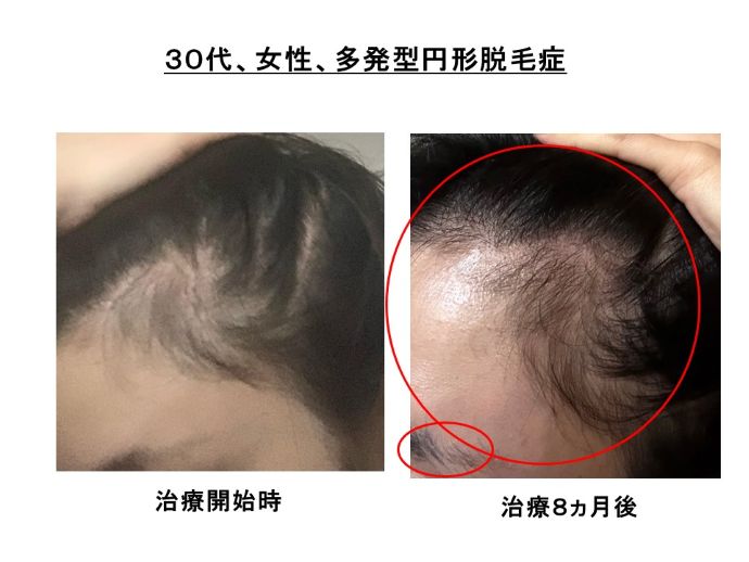 円形脱毛症　病院